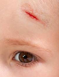 Accident Nursery Child Accidents First